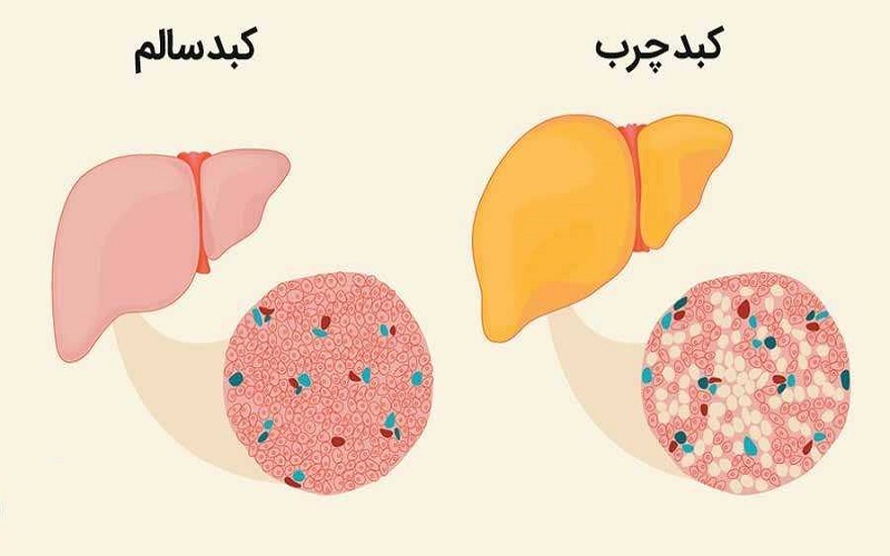 کبد چرب