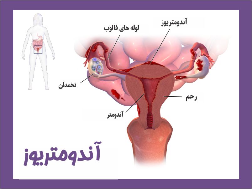 اندومتریوز