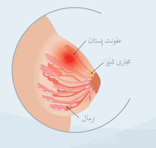 عفونت های پستان در زنان 