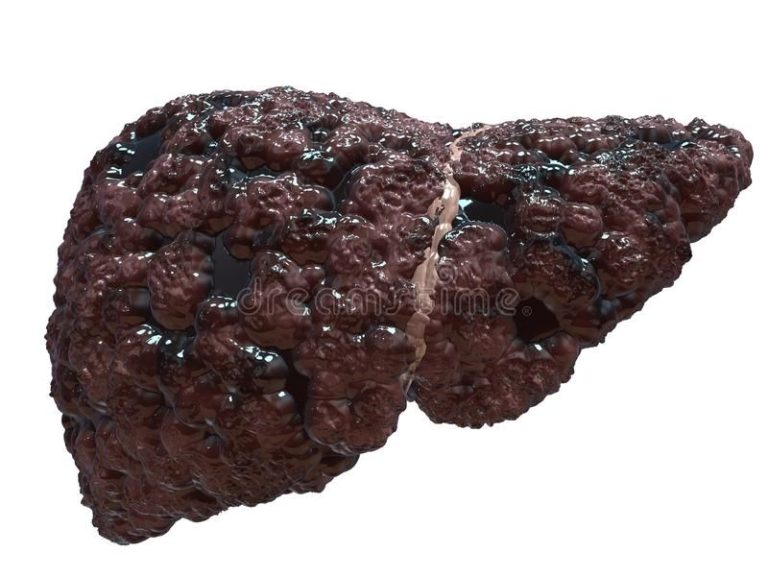 سیروز کبدی