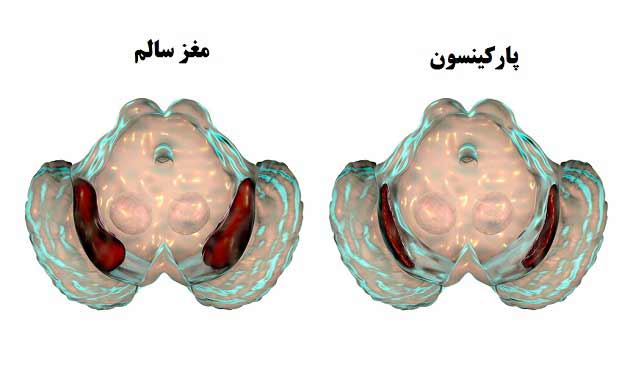 پارکینسون 