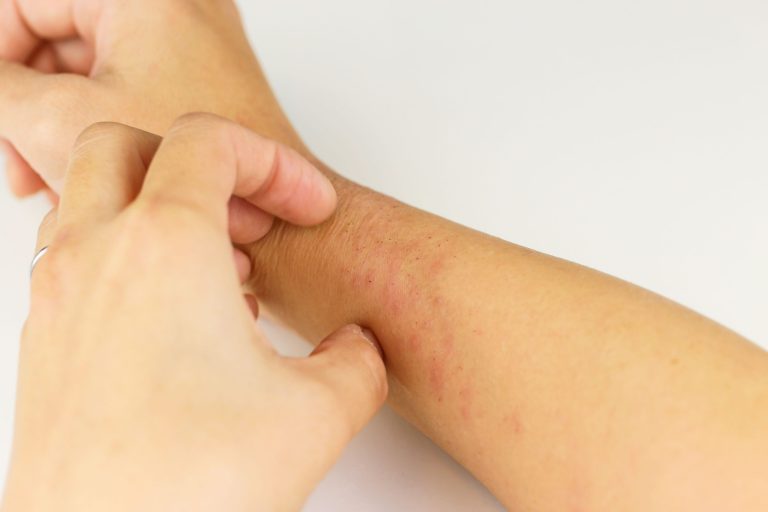 تدابیر اگزما و خارش