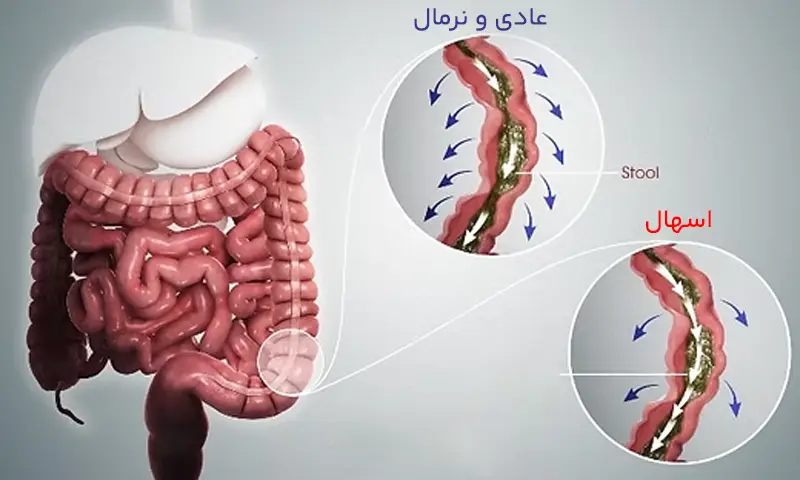 تدابیر اسهال