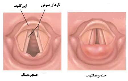 لارنژیت یا التهاب حنجره