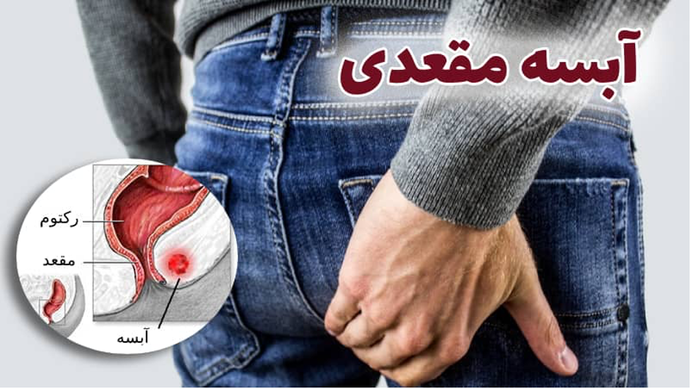آبسه آنورکتال