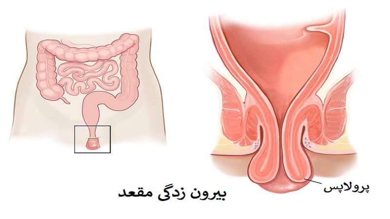 پرولاپس رکتوم