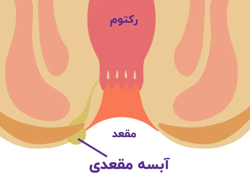 آبسه آنورکتال