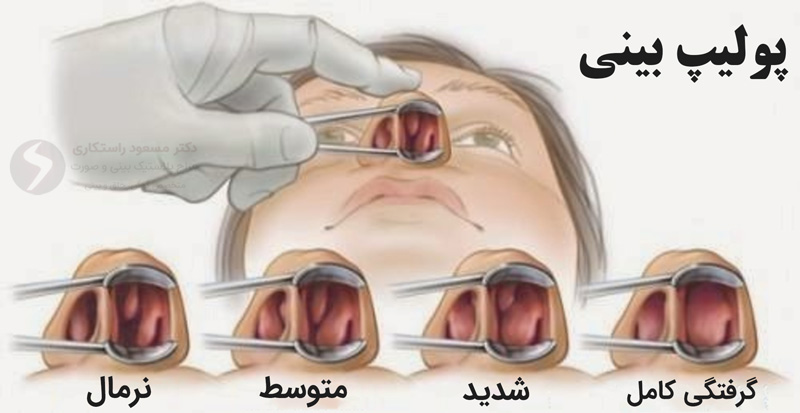 پولیپ بینی 