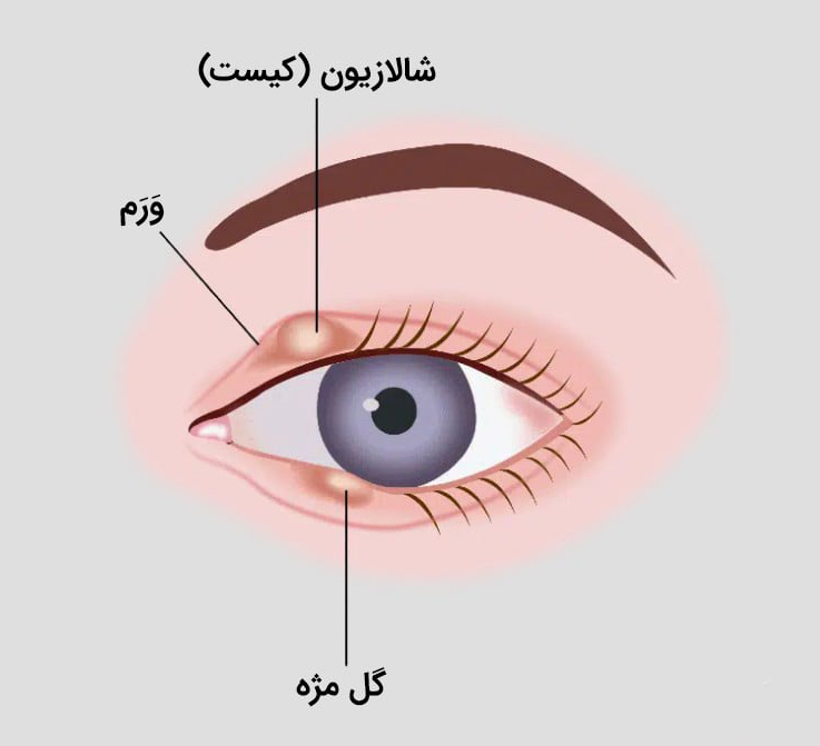 شالازیون