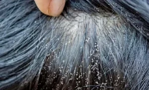 تدابیر شپش