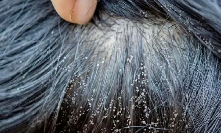 تدابیر شپش