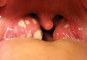 آبسه دور لوزه 