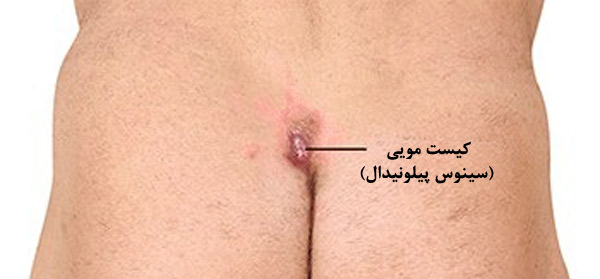 کیست یا سینوس پیلونیدال