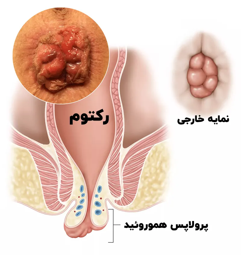 پرولاپس رکتوم