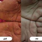 اگزمای دست قبل و بعد از درمان