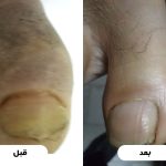 قبل و بعد انگشت دیابتی