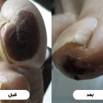 قبل و بعد انگشت دیابتی
