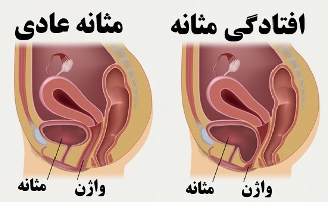 افتادگی رحم و مثانه