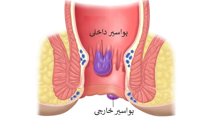 بواسیر