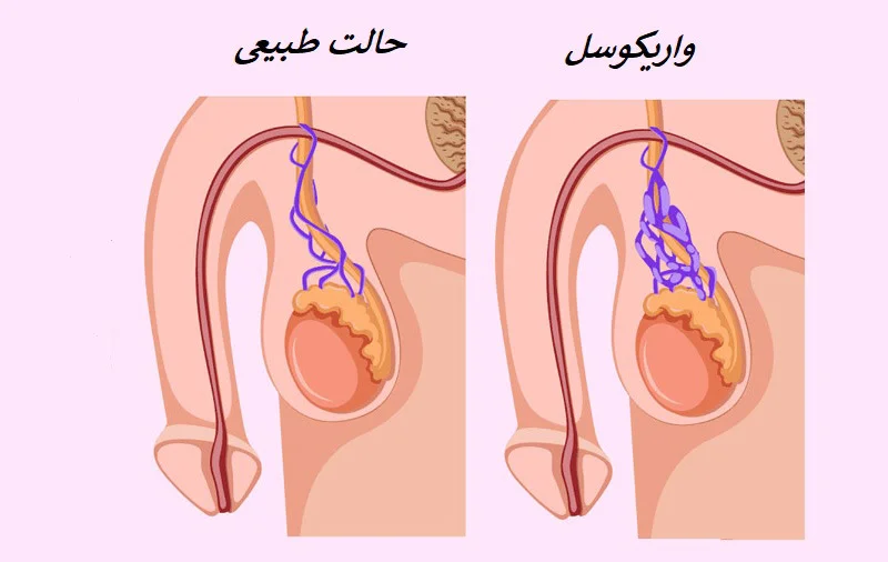 واریکوسل