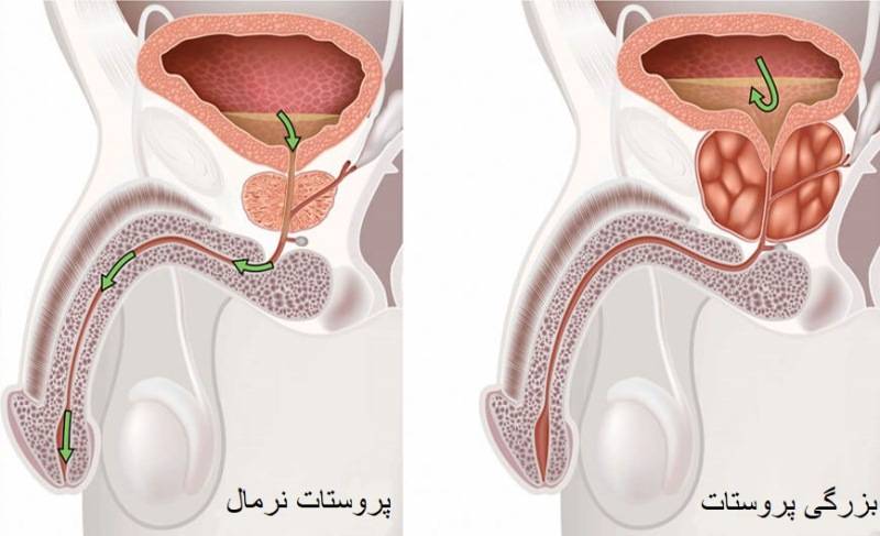 پروستات