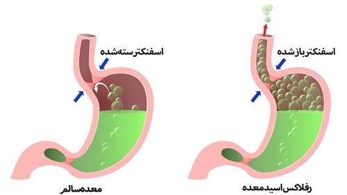 علائم-رفلاکس-معده