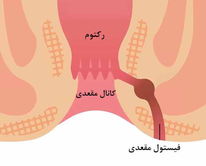 فیستول مقعدی