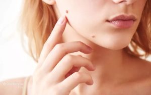  خال را برداریم یا دست نزنیم؟