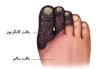 کانگرن یا قانقاریا 
