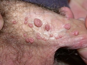 زگیل آلت تناسلی (برآمدگی ویروسی در انسان یا HPV)