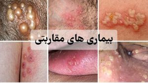 بیماری مقاربتی