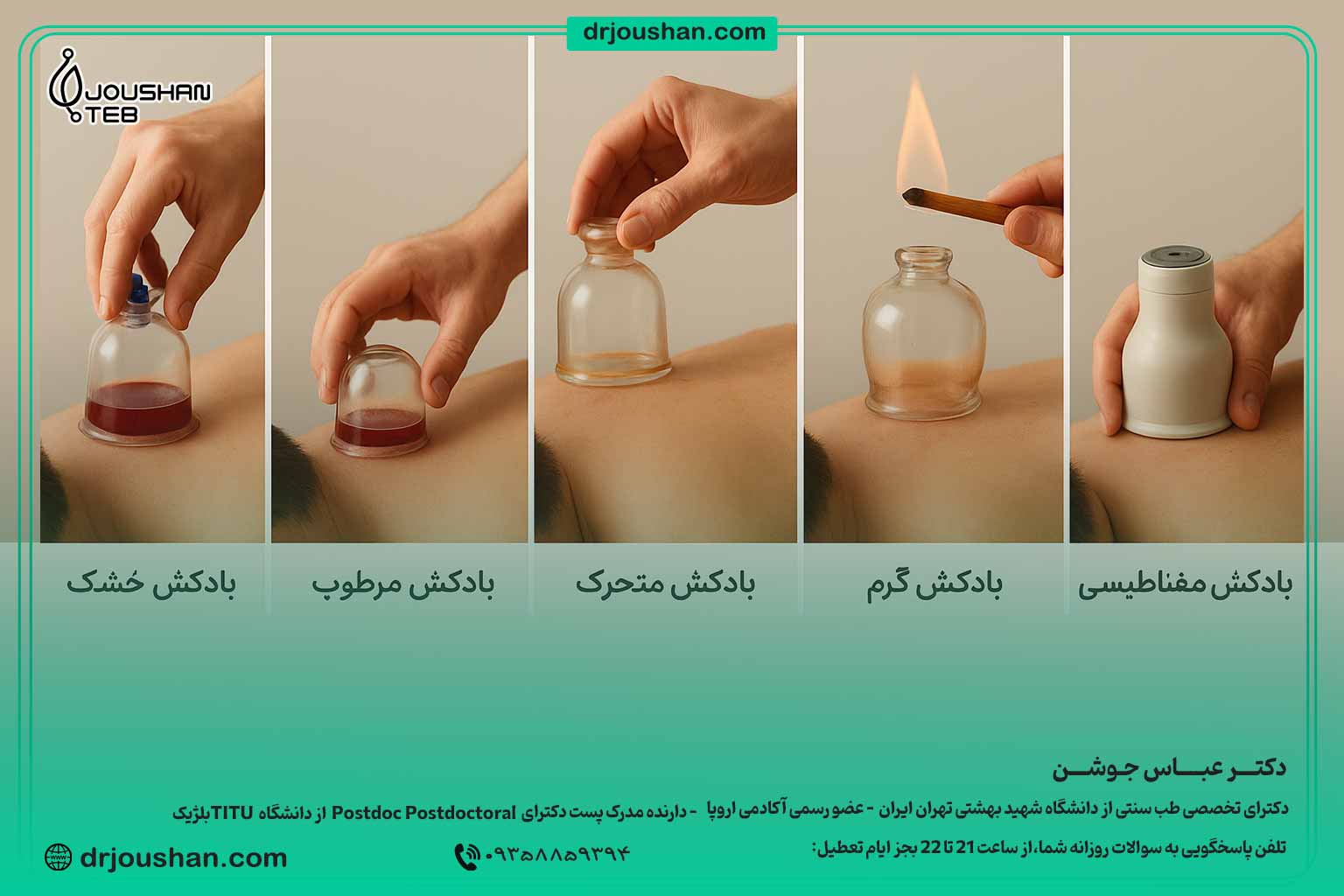 انواع-بادکش-در-طب-سنتی