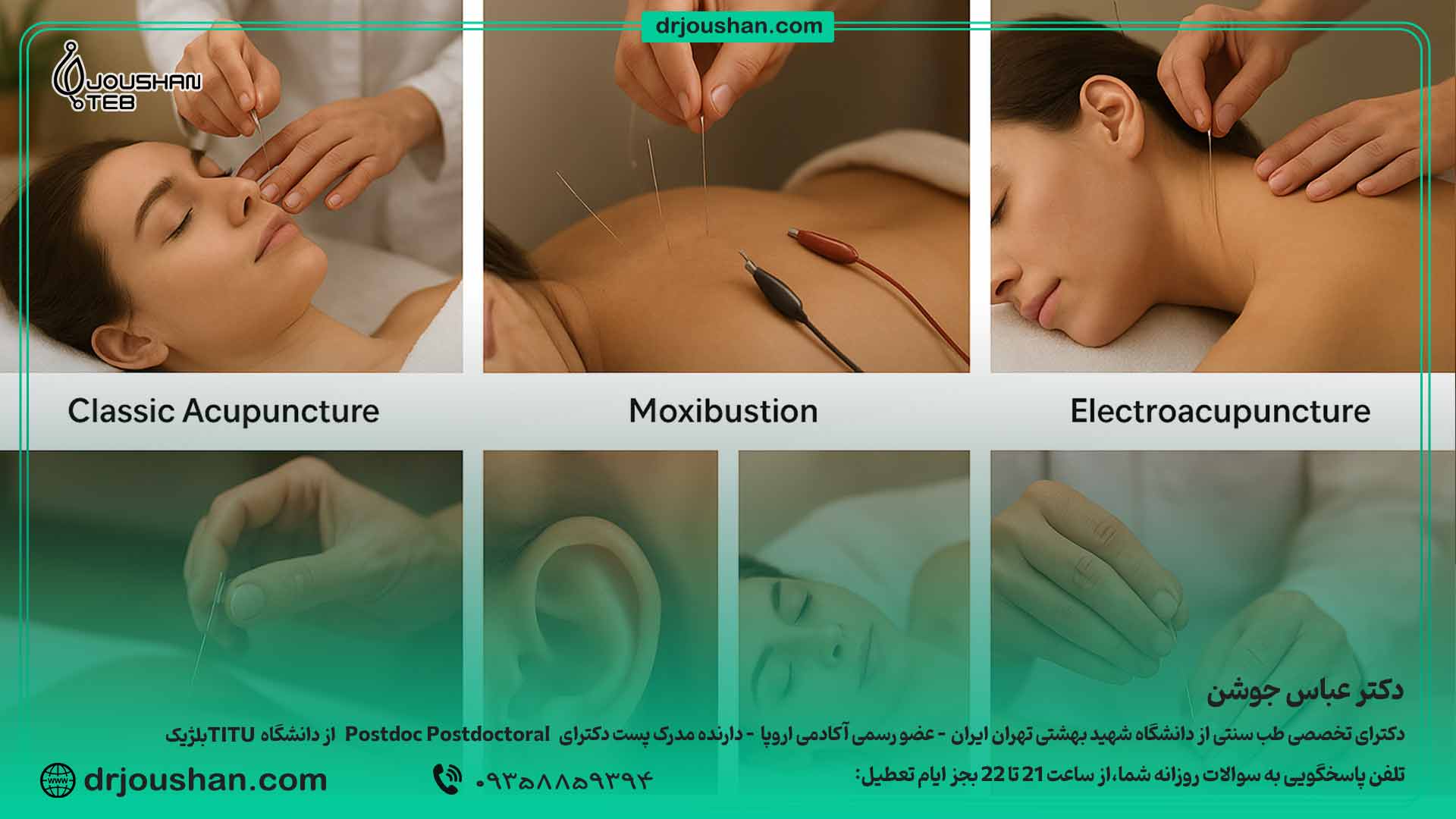  انواع روش‌های طب سوزنی