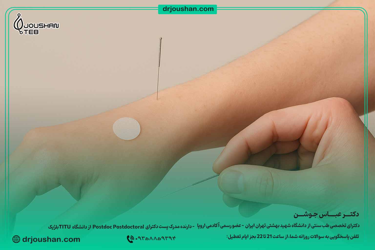  انواع-نقاط-طب-سوزنی