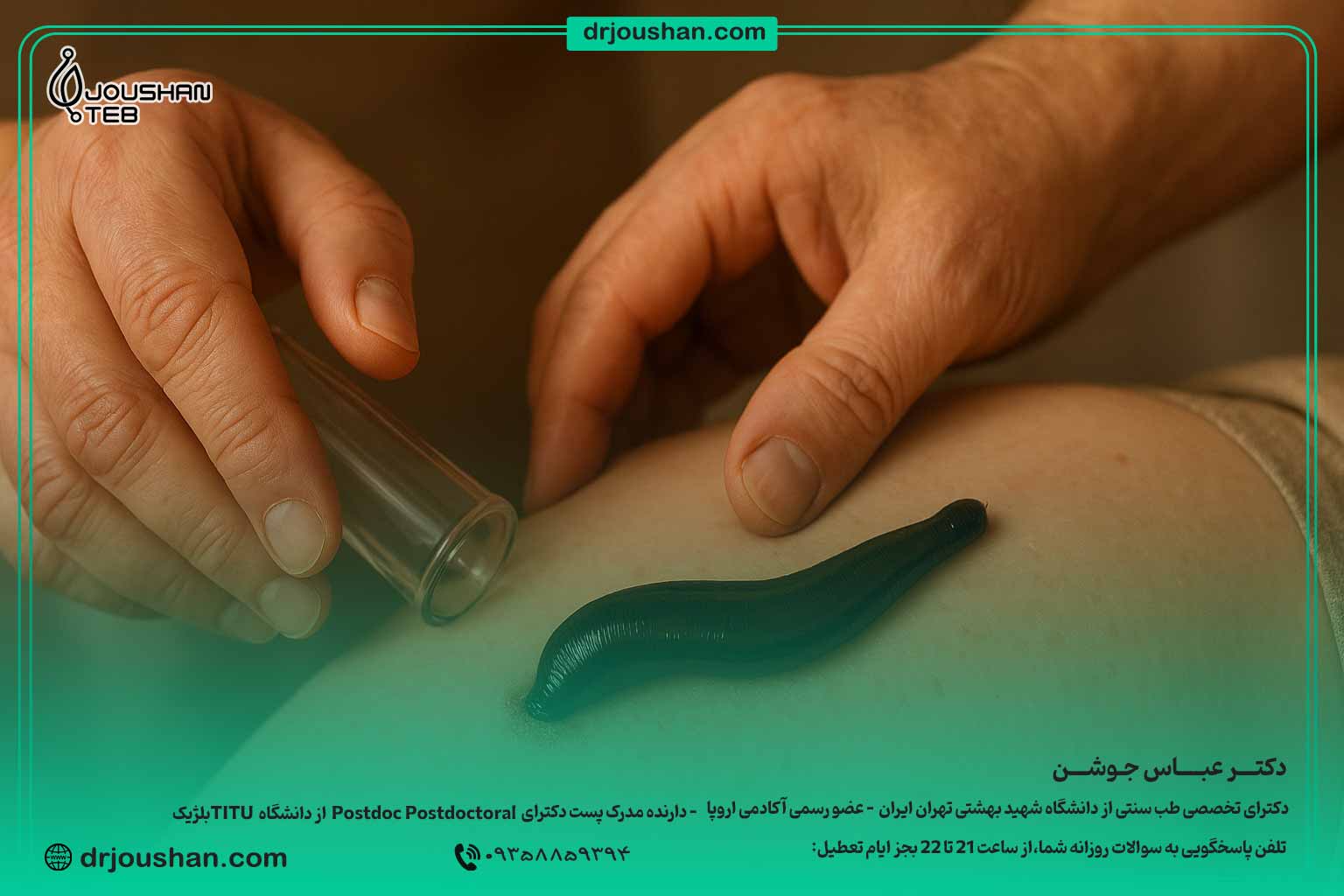  زالودرمانی در طب سنتی