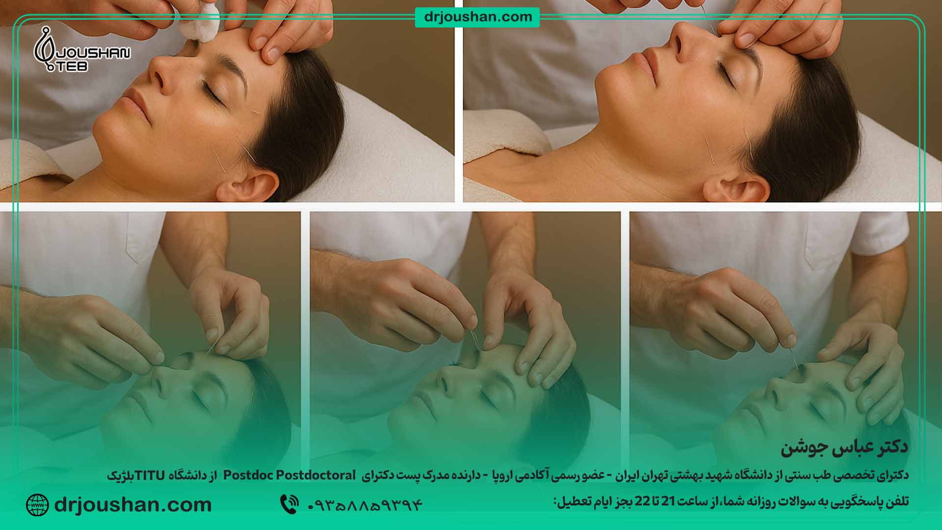  مراحل-انجام-متد-مرسوم-سوزن‌زنی