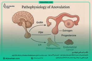 پاتوفیزیولوژی-عدم-تخمک‌گذاری