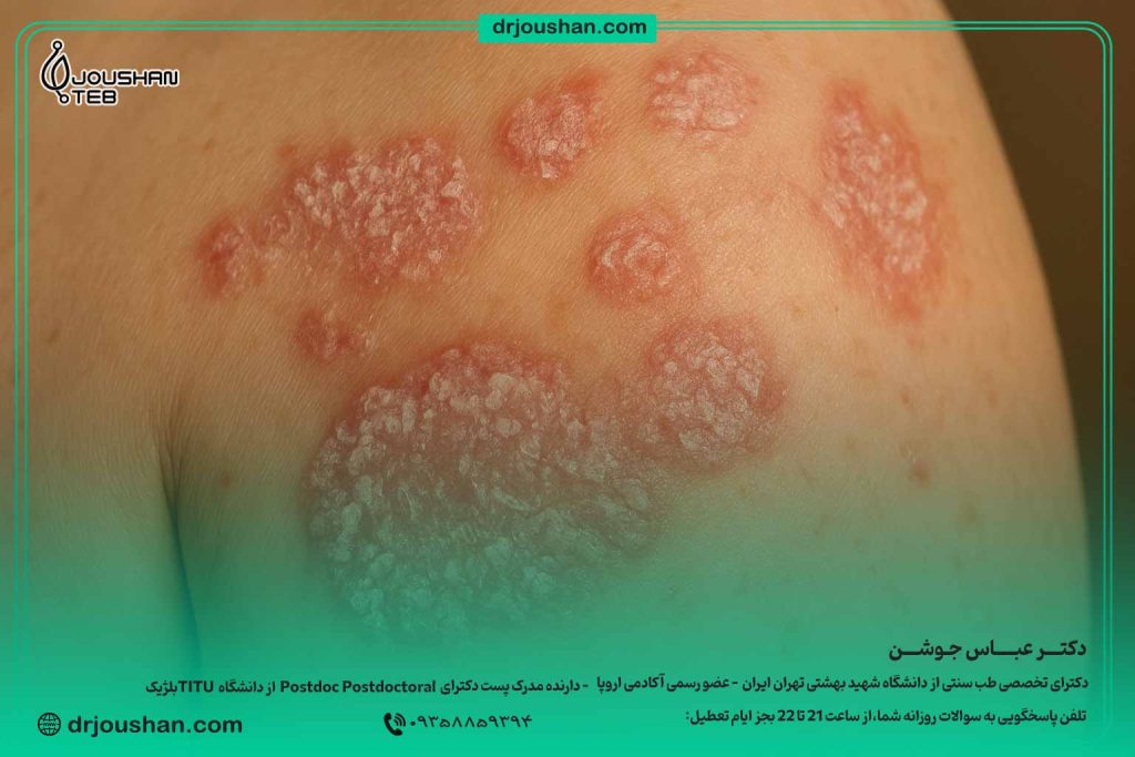 پسوریازیس-(داء-الصدف)