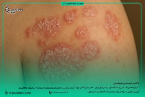 پسوریازیس-(داء-الصدف)