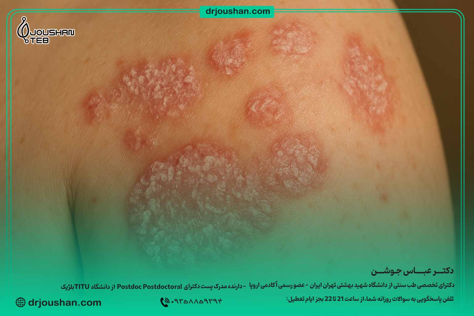 پسوریازیس-(داء-الصدف)