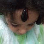 آلوپیسی در کودکان و زالو درمانی