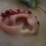 حجامت برای درمان زردی نوزاد