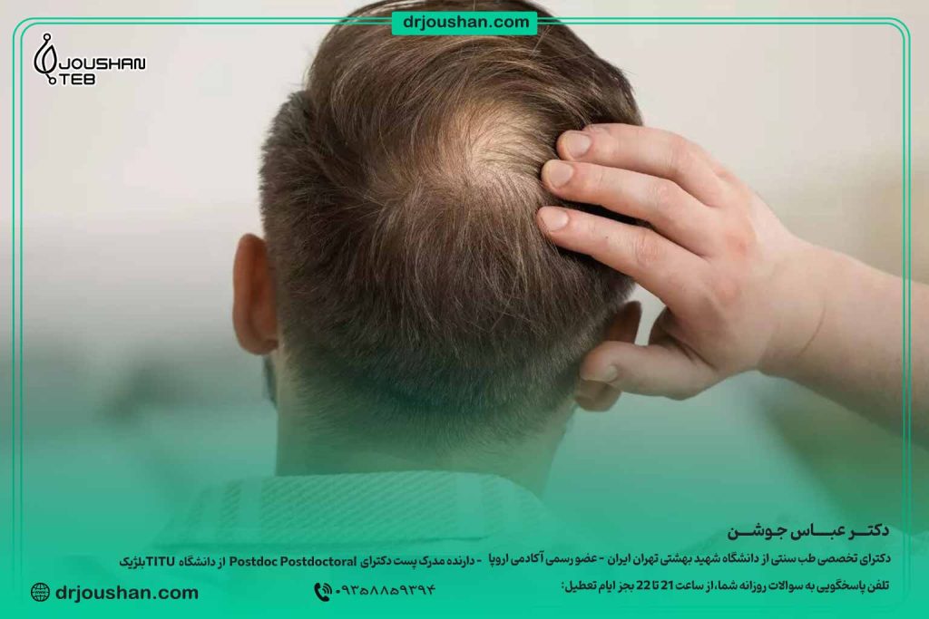 درمان-ریزش-مو