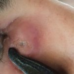 درمان عفونت کنار چشم و زالو درمانی(طب سنتی) _ دکتر عباس جوشن