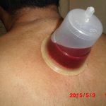 مراحل انجام حجامت اصولی و صحیح - دکتر عباس جوشن