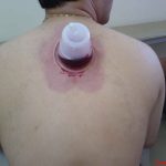 مراحل انجام حجامت اصولی و صحیح - دکتر عباس جوشن