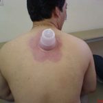 مراحل انجام حجامت اصولی و صحیح - دکتر عباس جوشن