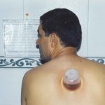 مراحل انجام حجامت اصولی و صحیح - دکتر عباس جوشن
