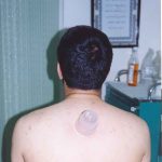 مراحل انجام حجامت اصولی و صحیح - دکتر عباس جوشن