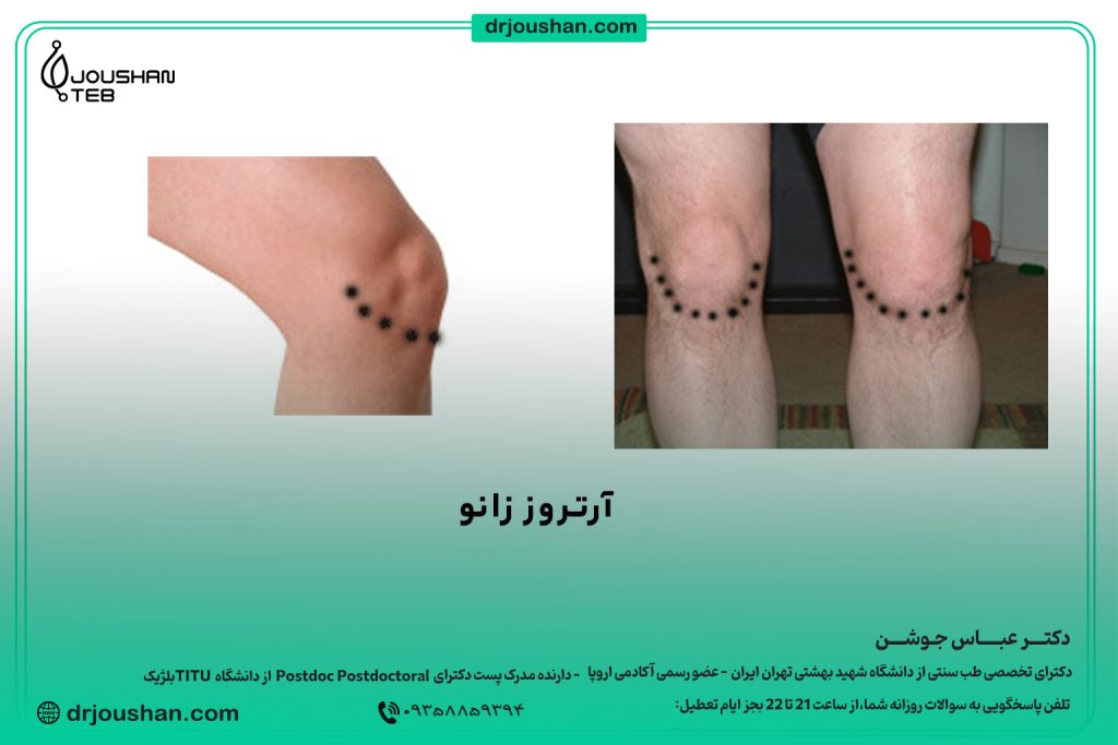 زالو گذاری آرتروز زانو
